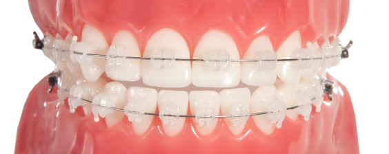 invisible braces with color