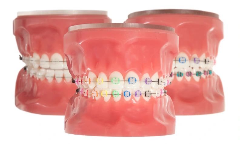 Colored ceramic deals braces